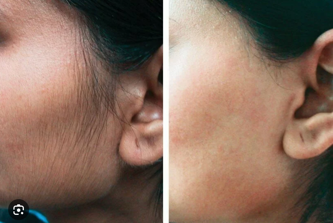 Laser Hair removal face result