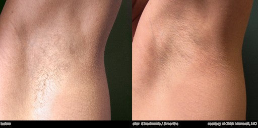 Underarm laser hair removal before and after, 5 treatments