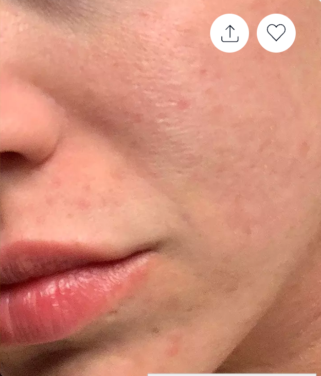 laser face treatment