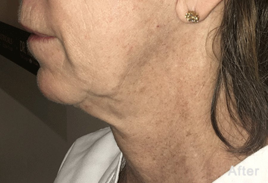 Neck and jawline after Morpheus8 RF microneedling