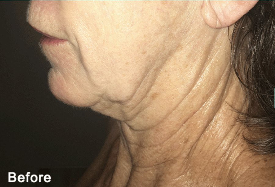 Neck and jawline before Morpheus8 RF microneedling