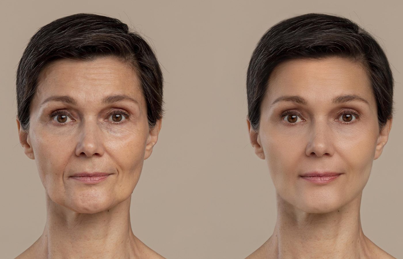 Brighter, more even skin tone after a chemical peel in Plano, TX